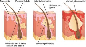 The process of formation of Acne within our skin, what is acne, how is acne formed