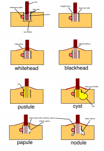 types of acne, various forms of acne, papule, pustle, nodule, cyst, blackheads and whiteheads