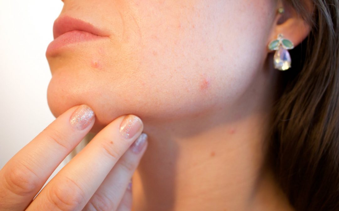 Image showing the formation of acne and pimples on skin.