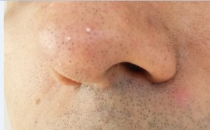 Picture of a nose showing difference between Blackheads, Whiteheads & Papule, acne, pimples