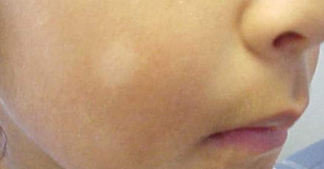 Pityriasis Alba – White spots on face of child