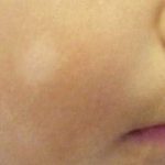 Pityriasis Alba or white spots of growing children's face