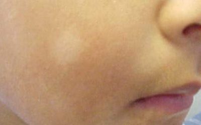 Pityriasis Alba – White spots on face of child