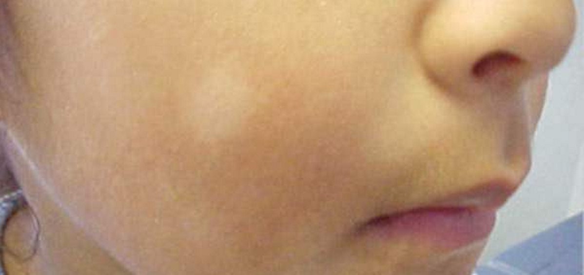 My Kid Has White Spots On His Face Infoupdate Org My Kid Has White Spots On His Face Infoupdate Org