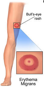 The rash (Erythema Migrans) at the site of tick bite gets larger in size (approximately 5 cm in diameter) in subsequent days with central clearing giving it a Bull’s eye on dartboard appearance.