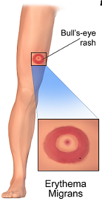 The rash (Erythema Migrans) at the site of tick bite gets larger in size (approximately 5 cm in diameter) in subsequent days with central clearing giving it a Bull’s eye on dartboard appearance. 