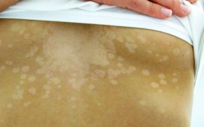 Tinea Versicolor: White spots on neck, shoulders