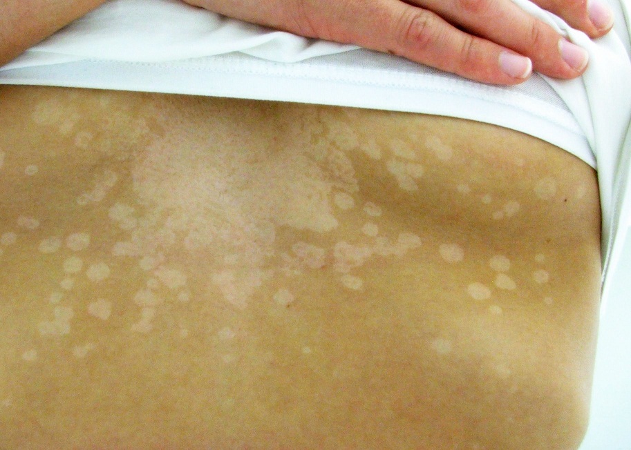 Tinea Versicolor: White spots on neck, shoulders